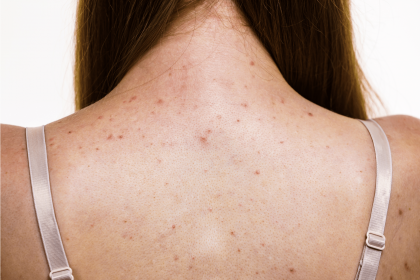 acne back facial
