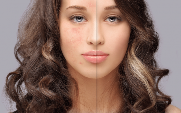 Foods you should avoid if you are dealing with Acne