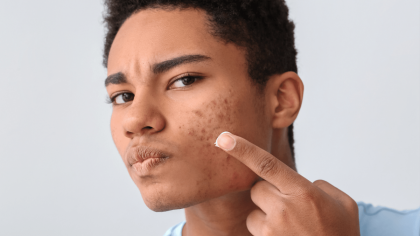 Conquering Inflammatory Acne