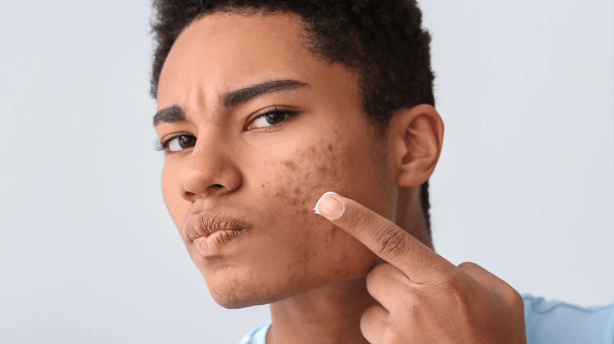 Conquering Inflammatory Acne