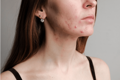 Understanding Hormonal Acne