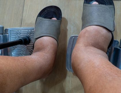 Lymphedema, and Dry Skin