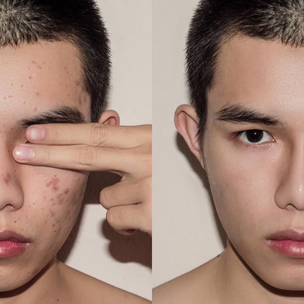 Acne clinic San Diego